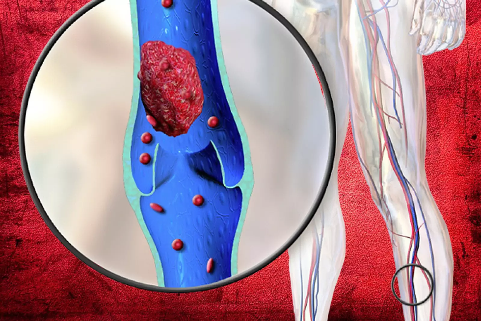 Тромбоз глубоких вен. 
