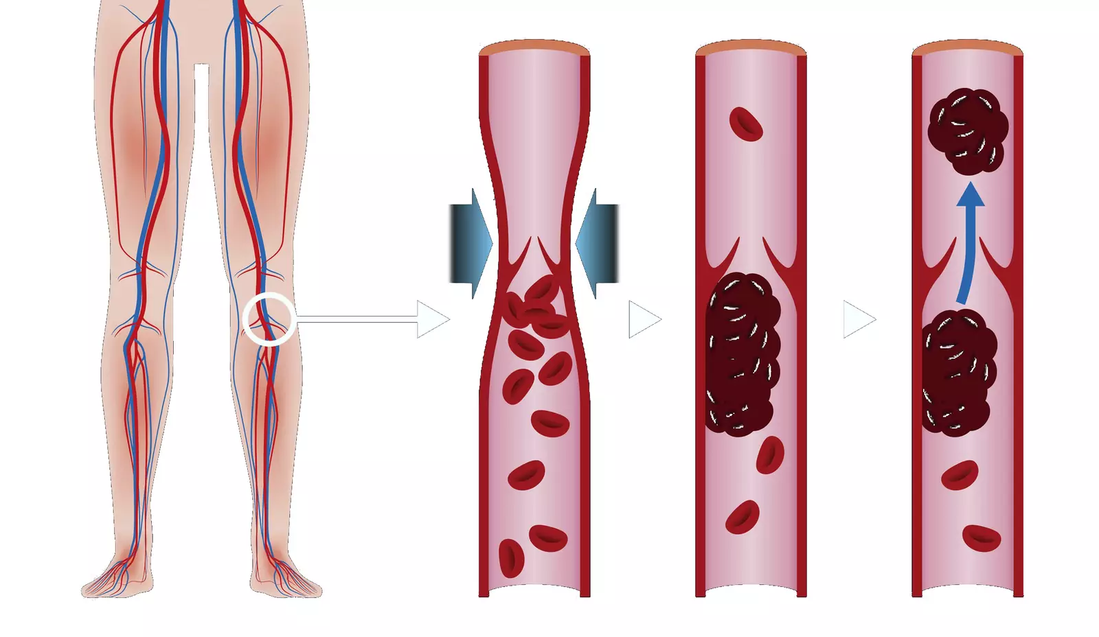Больница Вересаева демонстрирует механизм образования тромбов с рисков их отрыва в общий кровоток. Больница Вересаева демонстрирует механизм образования тромбов с рисков их отрыва в общий кровоток.