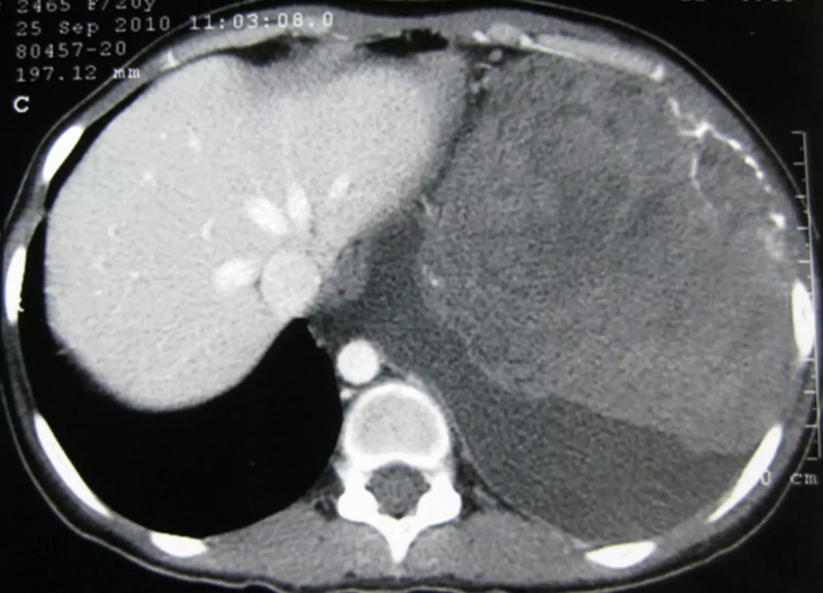 Нейробластома. Нейробластома.