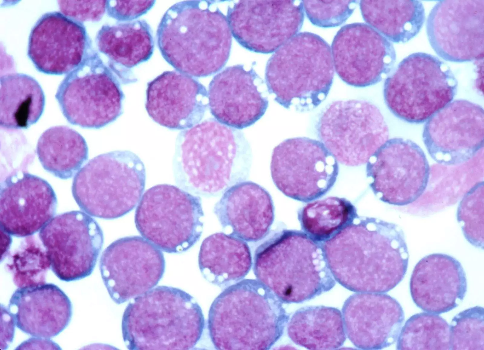 Вирус Эпштейна — Барр под микроскопом.